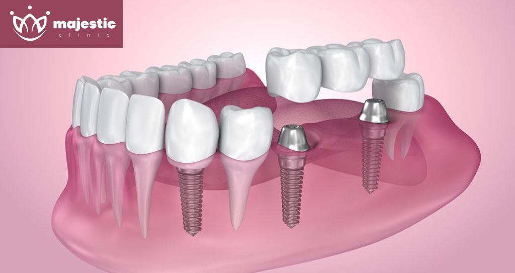Best Dental Implants in Istanbul, Turkey | Dental Implants Istanbul | Istanbul Teeth Implants | Teeth Implants in Istanbul - Majestic Clinic Smile