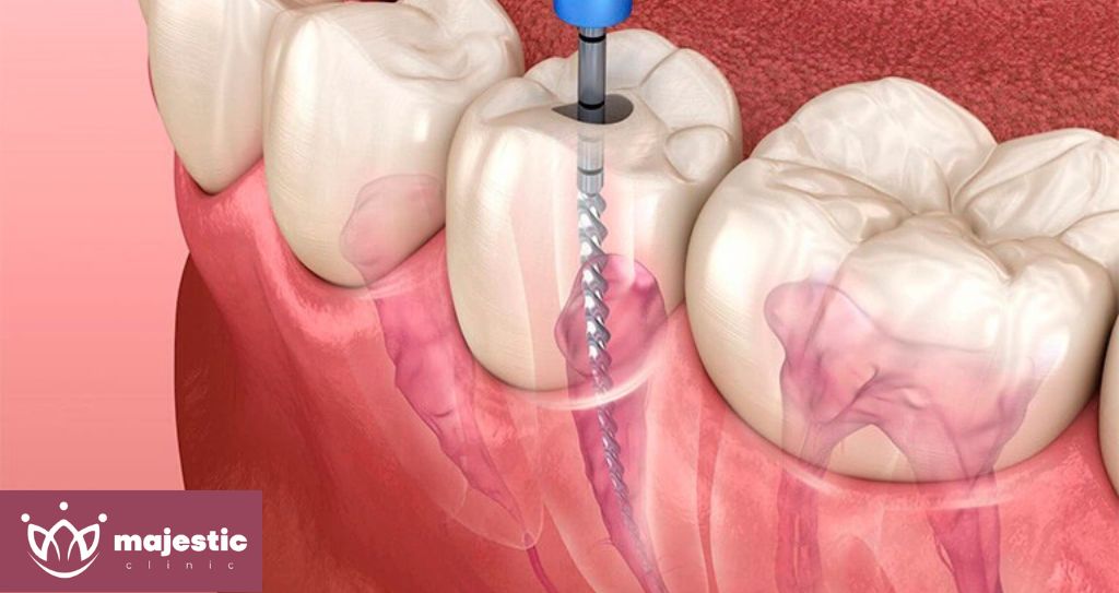 Best Root Canal Treatment in Istanbul, Turkey: Cost, Procedure - Majestic Clinic Smile