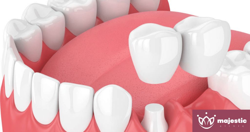 İstanbul, Türkiye'de Diş Köprüsü Kliniği: Kurulum, Prosedür ve Maliyetler - Majestic Clinic Smile