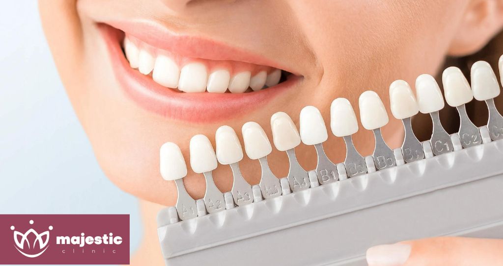 Facettes dentaires 1 Clinique de facettes dentaires à Istanbul, Turquie : Facettes dentaires complètes - Majestic Clinic Smile
