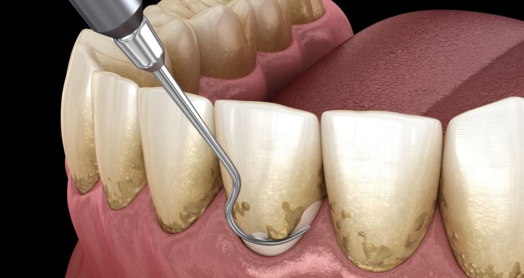 Commencez votre voyage vers des gencives plus saines - Majestic Clinic Smile