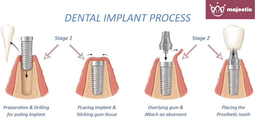 Process of Getting Istanbul Teeth Implants - Majestic Clinic Smile