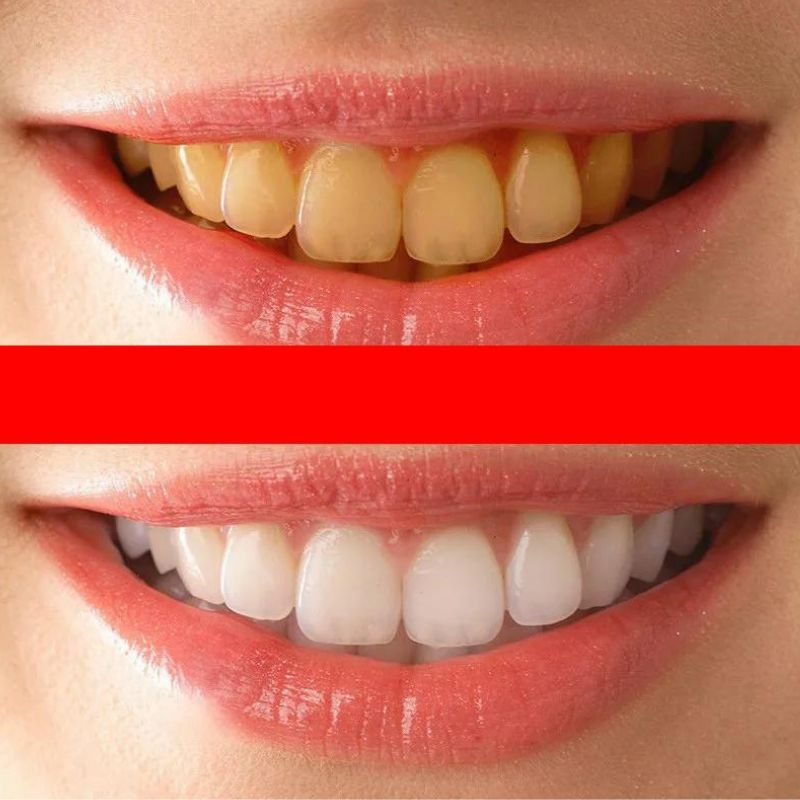 Hollywood Gülüşü Öncesi ve Sonrası - Majestic Klinik Gülüşü